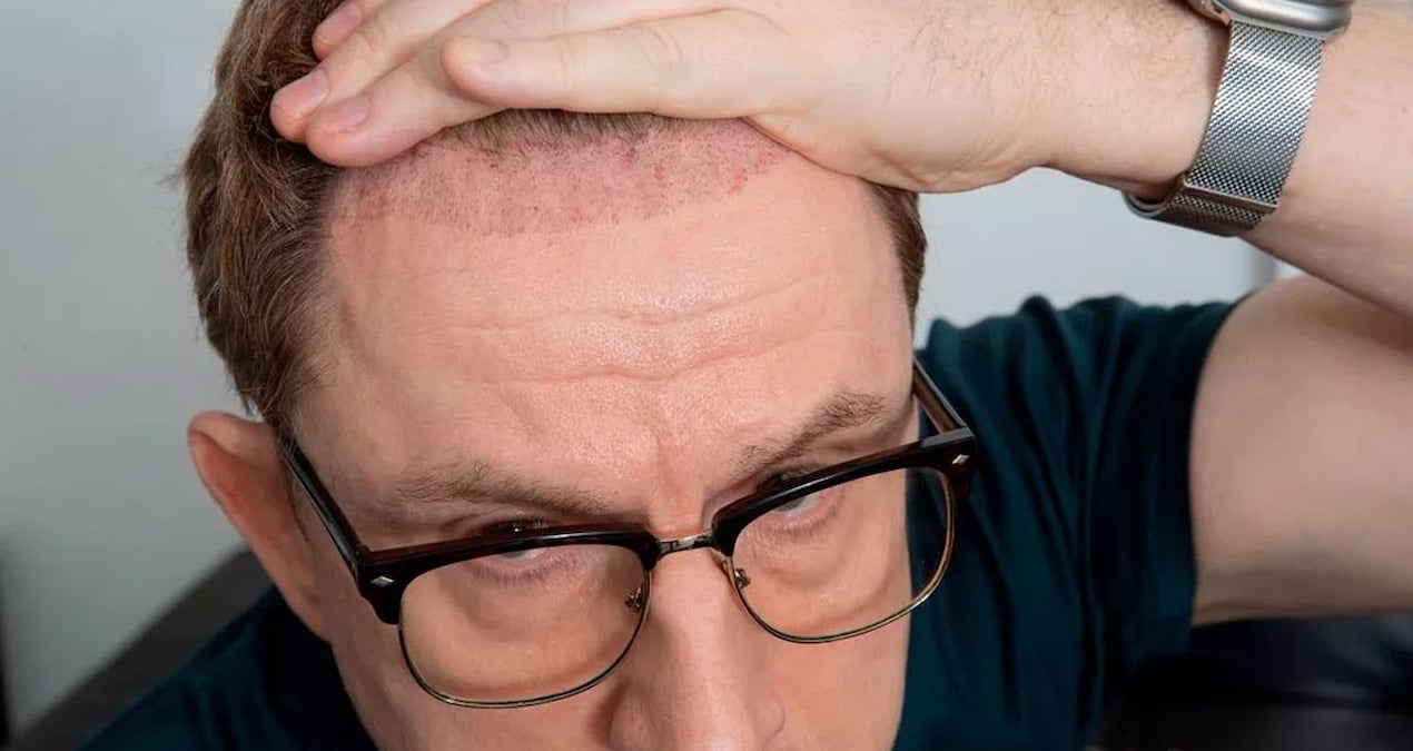 Saç ekimi hayatını mahvetti: İşinden oldu